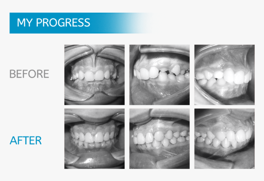 Midwest Orthodontics Chicago - Teeth Xray Before And After Braces, HD Png Download