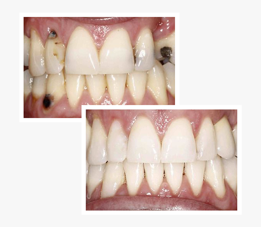 Horizon Microscope Enhanced Dentistry - Full Mouth Reconstruction, HD Png Download