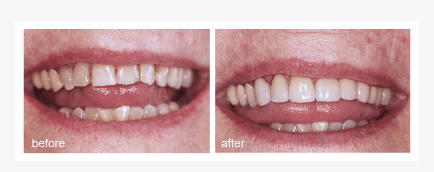 Shot Of Before And After Visiting Abington Smile Gallery - Mouth, HD Png Download
