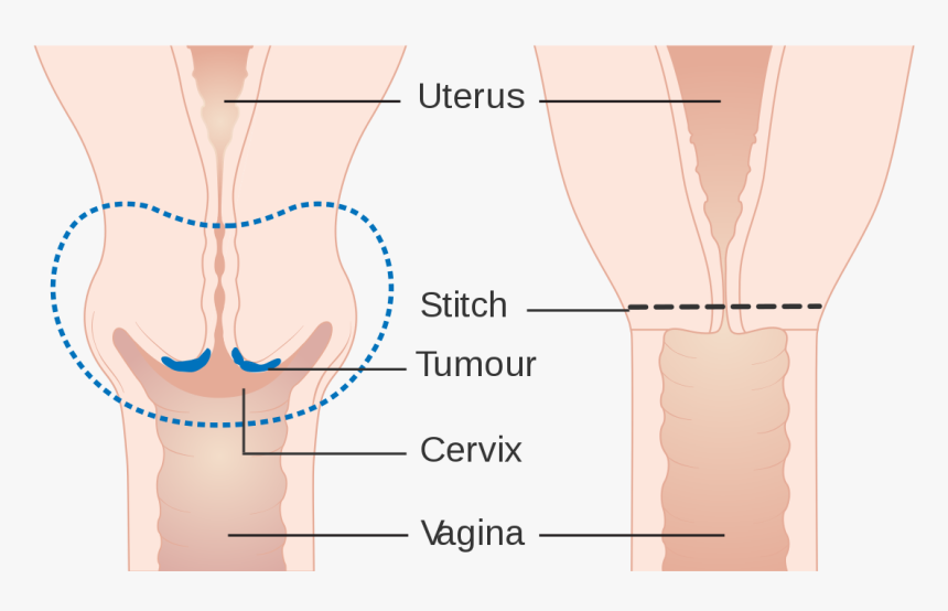 Cervical Amputation - Illustration, HD Png Download