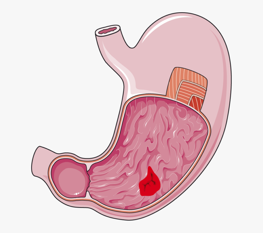 Stomach Ulcer Png, Transparent Png