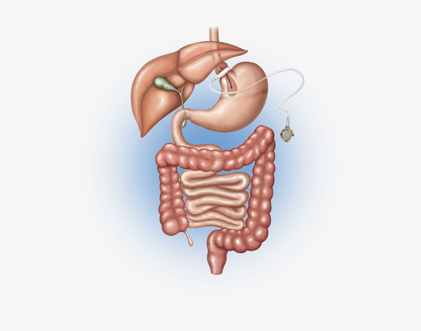 Vertical Sleeve Gastrectomy, HD Png Download
