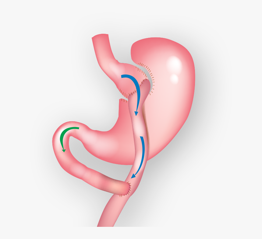 Demonstration Of Gastric Bypass Surgery - Gastric Bypass, HD Png Download
