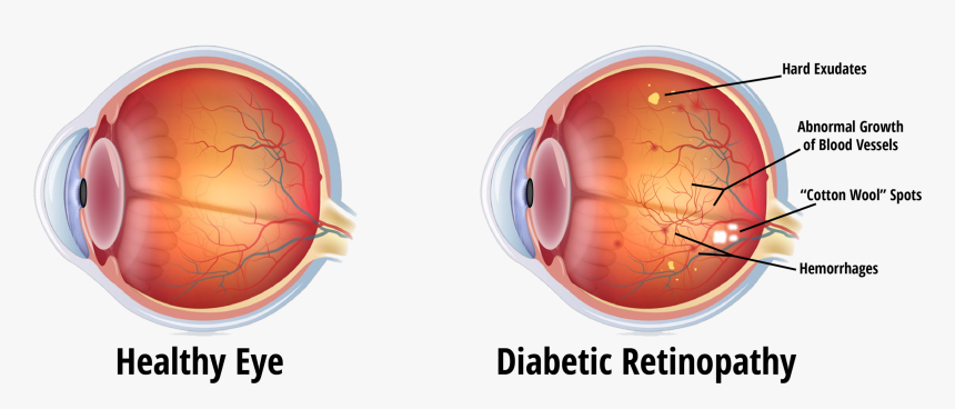 Eye During Diabetic Retinopathy, HD Png Download