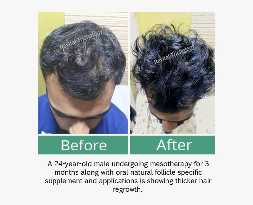Hair Loss In Men - Lace Wig, HD Png Download