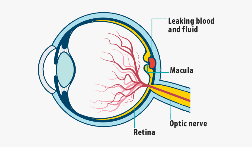 Picture Of Effects Of Wet Amd On The Eye, Showing Leaking - Eye Retinal Blood Vessel, HD Png Download
