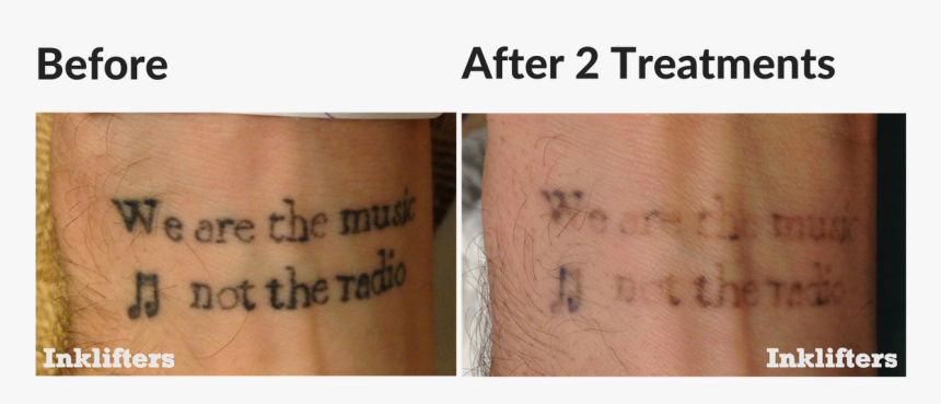Second Treatment Laser Tattoo Removal, HD Png Download