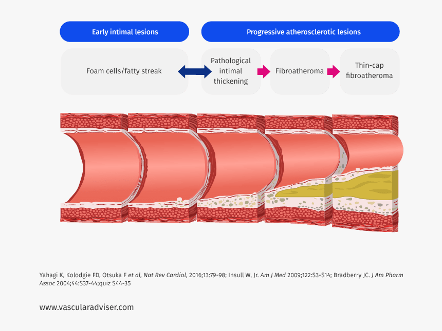 Atherosclerotic Lesion Development - Atherosclerotic Lesions, HD Png Download
