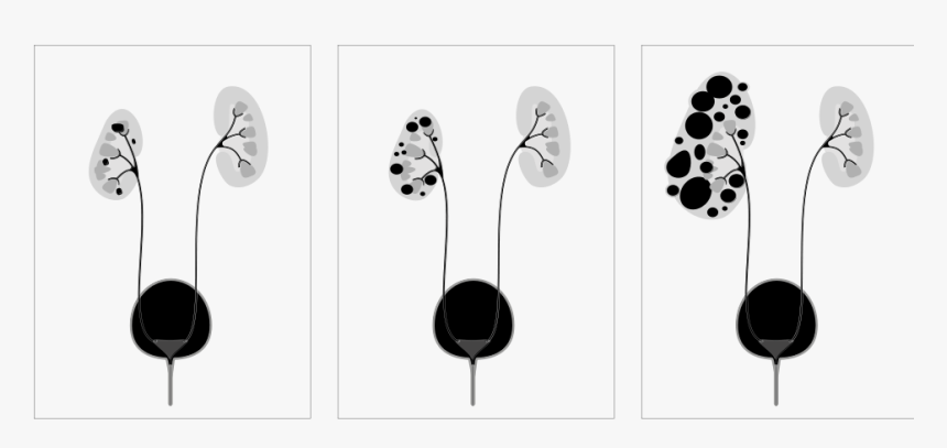 Polycystic Kidney Disease, HD Png Download
