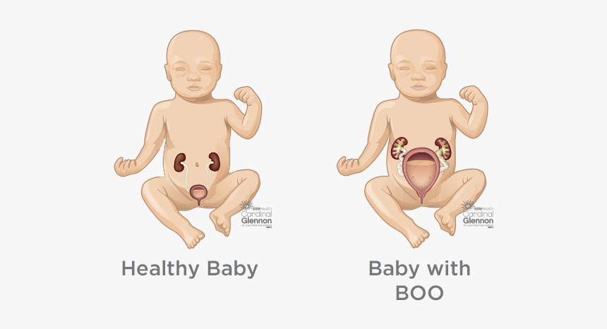 Bladder Outlet Obstruction, HD Png Download