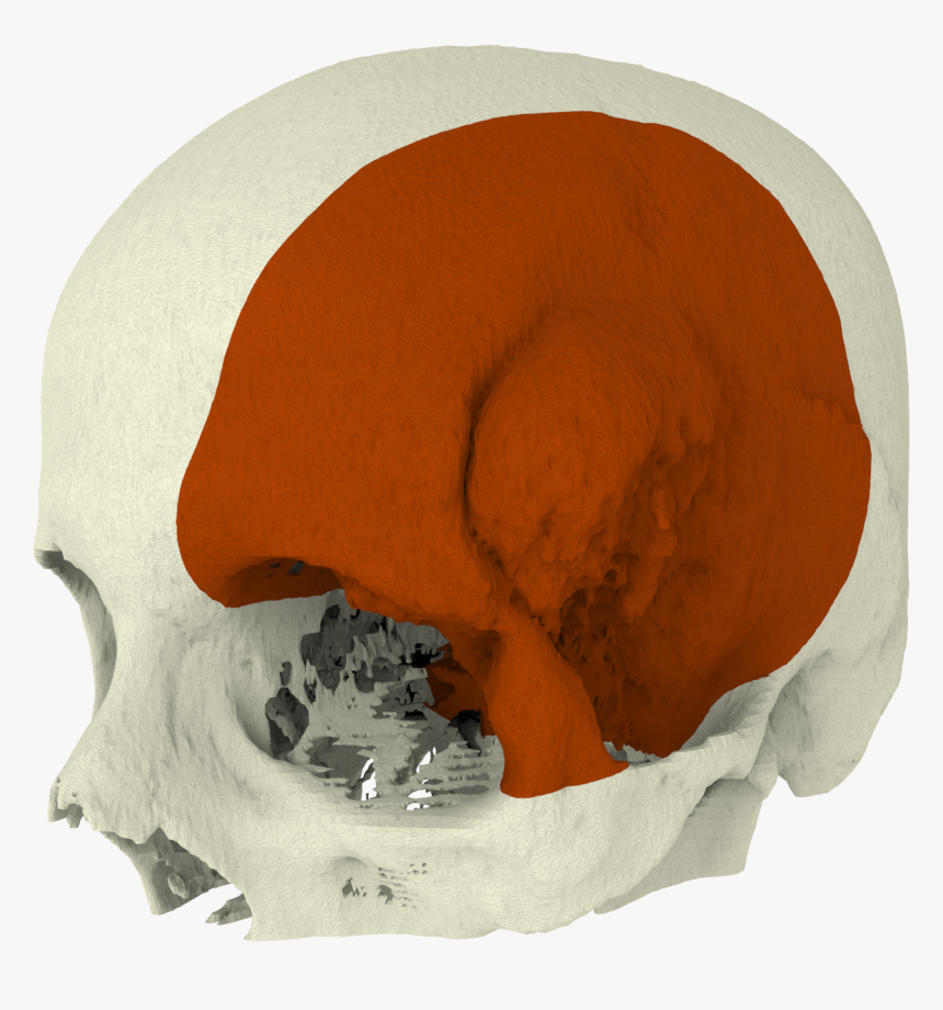 Meningioma2 - - Surgical Guide Cranial Implants, HD Png Download