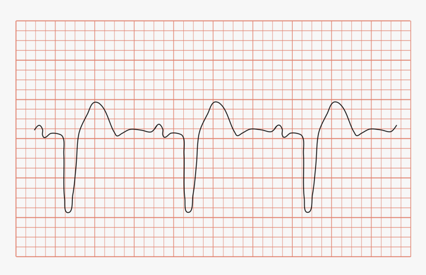Bundle Branch Block, HD Png Download