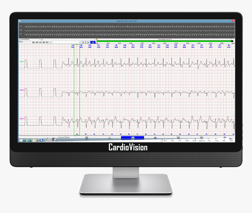 Enlarged Ecg Display, HD Png Download