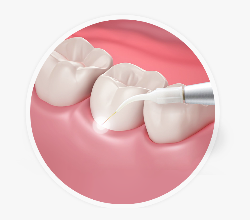 Transparent Laser Mouth - Gums, HD Png Download