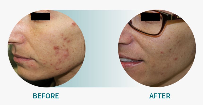Active Acne/acne Scars, HD Png Download