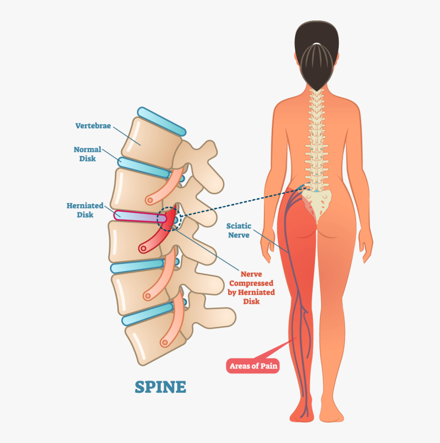 Left Side Sciatic Nerve Pain, HD Png Download
