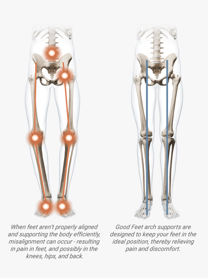 Arch Support Benefits - Orthopedic Bunion Corrector 2.0, HD Png Download