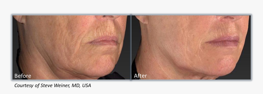 Genius Radio Frequency And Microneedling, HD Png Download