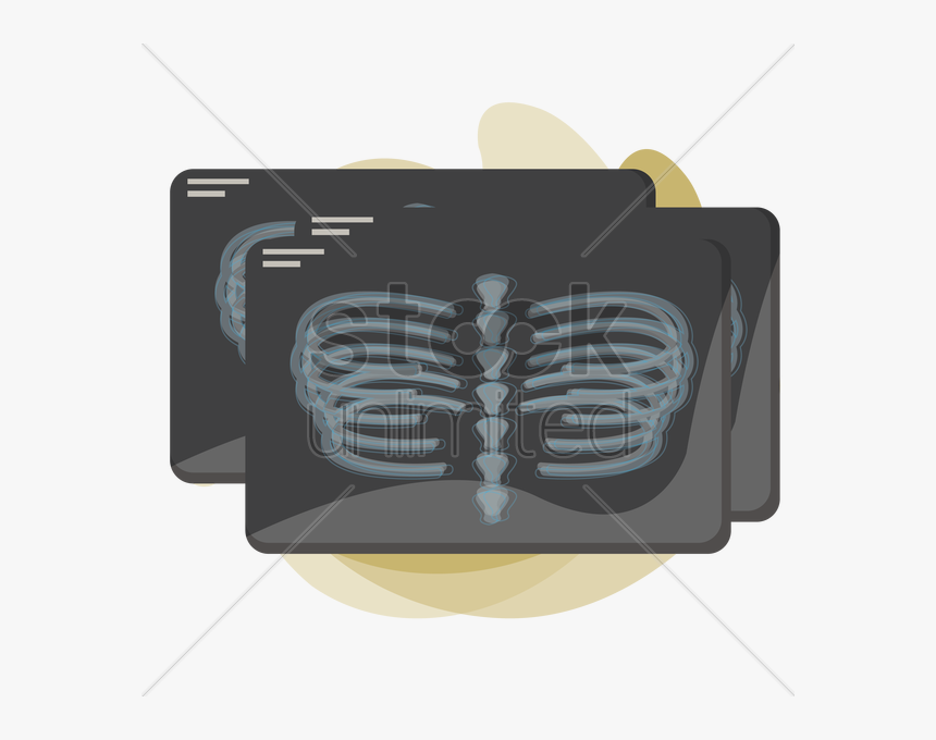 X-ray Of Human Rib Cage V矢量图形 - Illustration, HD Png Download