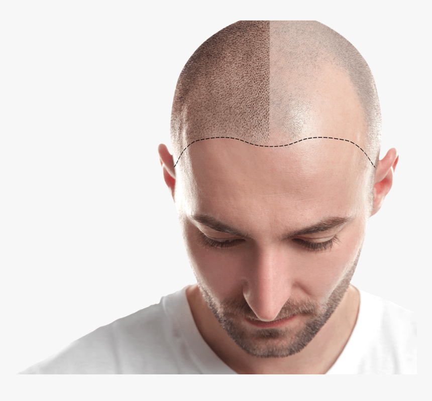 Hair Transplant In Ahmedabad - Transplant Add Fue Hair, HD Png Download