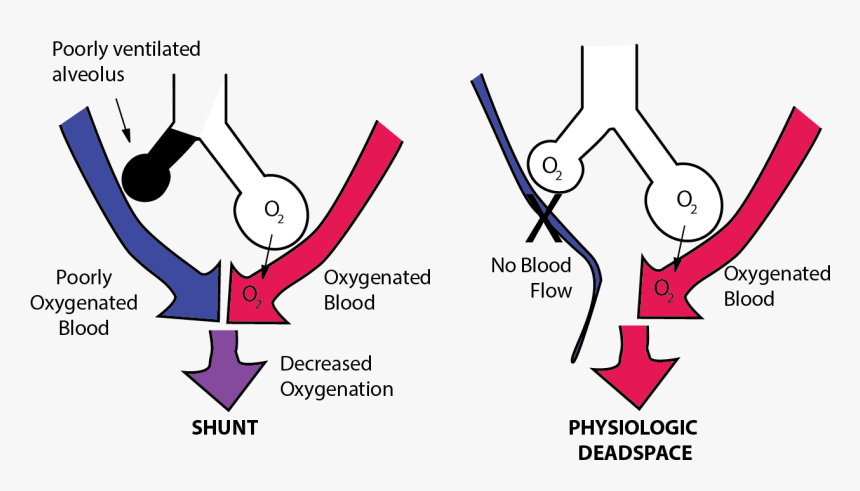 Imbalance Between Perfusion And Ventilation Is Called - Pulmonary Shunt, HD Png Download