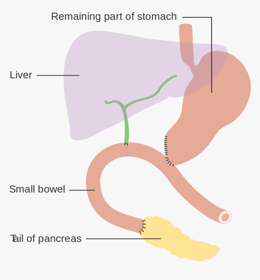 Pancreaticoduodenal Resection, HD Png Download
