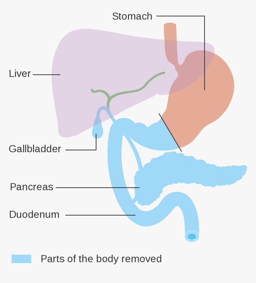 Total Pancreatectomy, HD Png Download