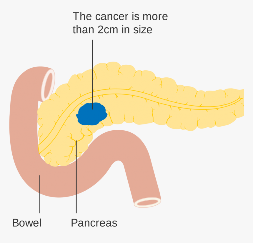 Pancreatic Cancer, HD Png Download