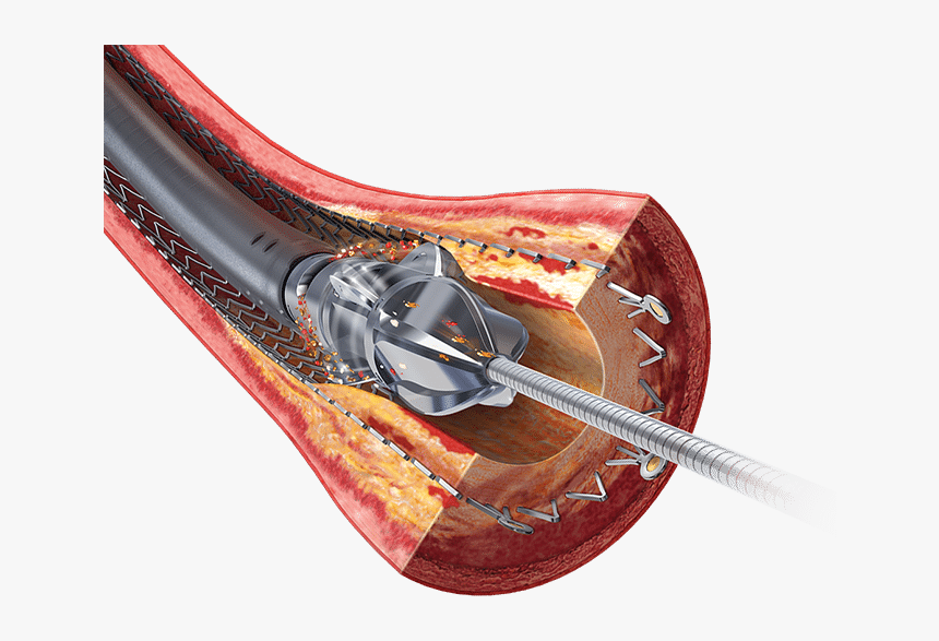 Stent Restenosis, HD Png Download
