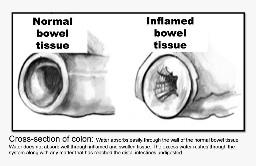 Inflamed Bowel, HD Png Download