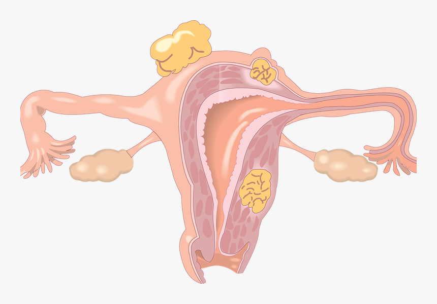 Free Childcare During Smear Tests In Amesbury - Polipy Szyjki Macicy, HD Png Download