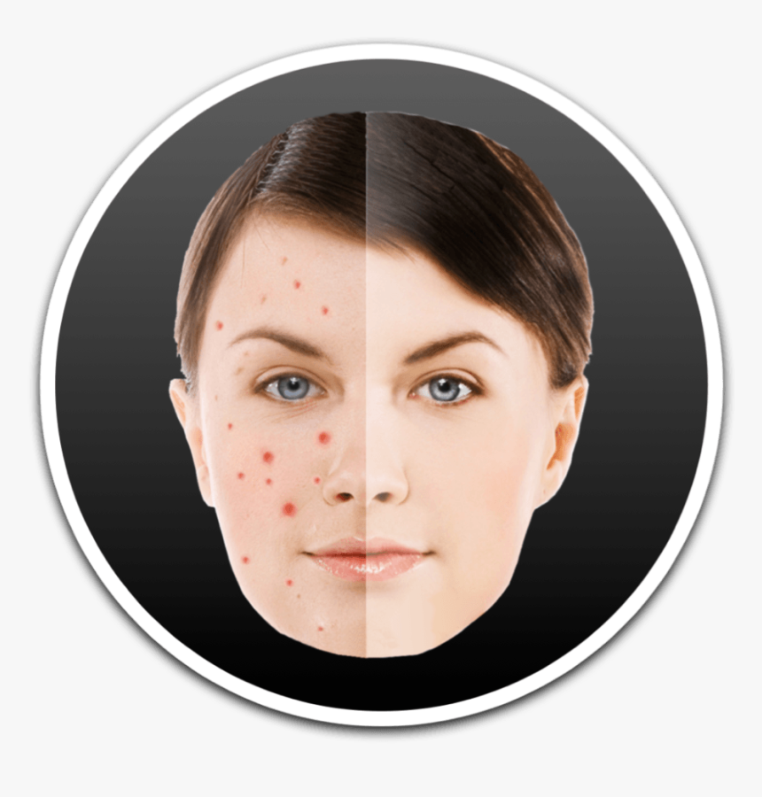 How To Remove Pimples And Blemish From Photos On Mac - Acne, HD Png Download
