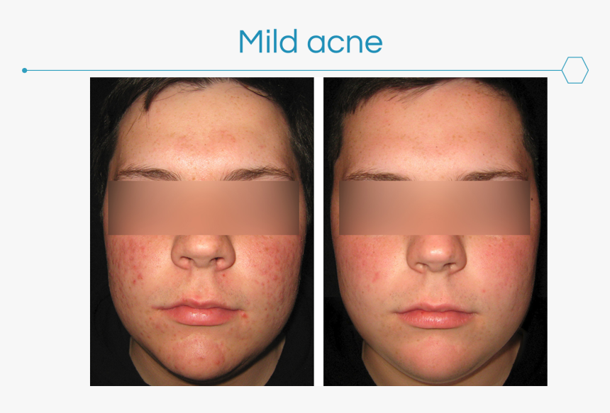 Picture3 - Acne Cosmetica, HD Png Download
