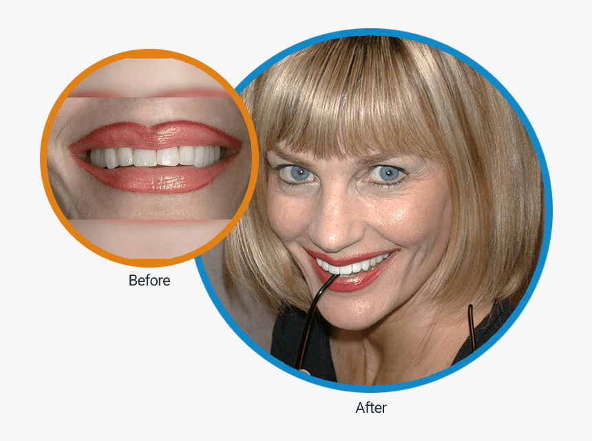 Close-up Before Of Diane S Mouth And Then An After - Girl, HD Png Download