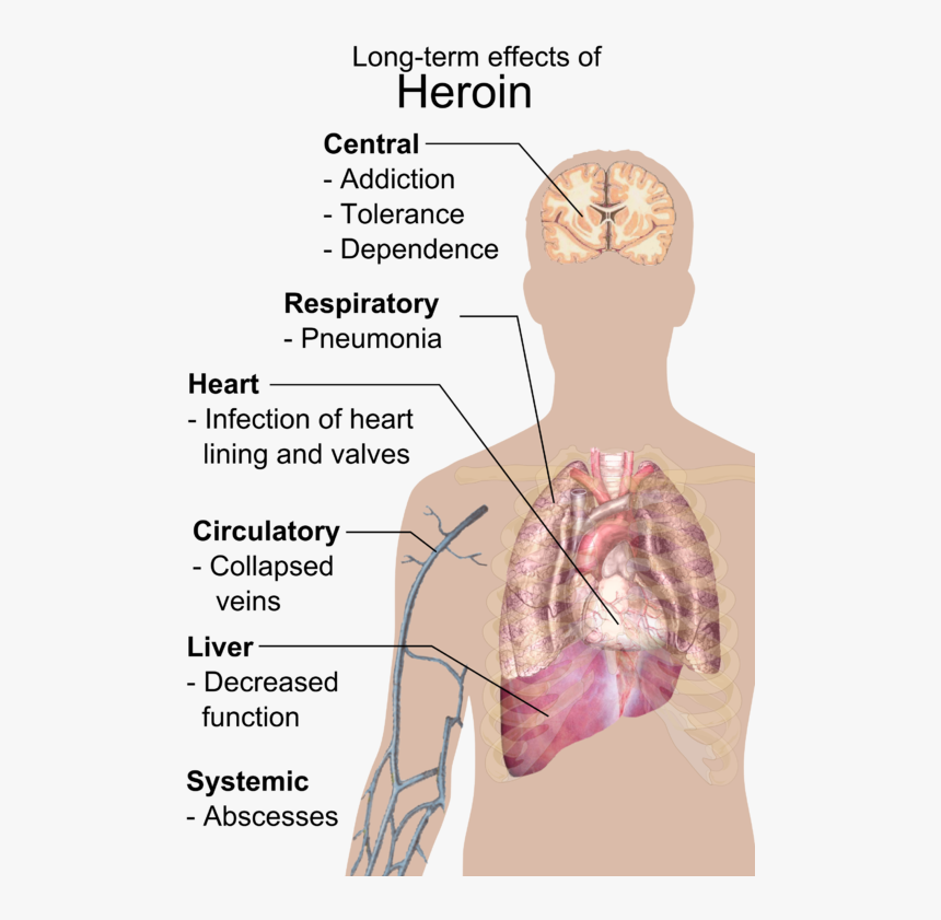 Long Term Effects Of Heroin, HD Png Download