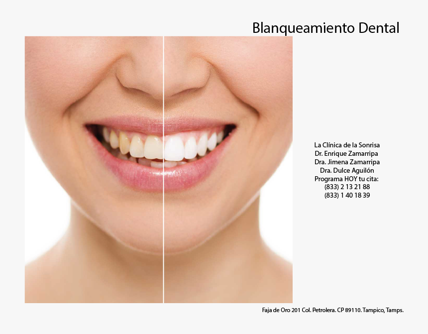 Aesthetic Teeth Restoration, HD Png Download