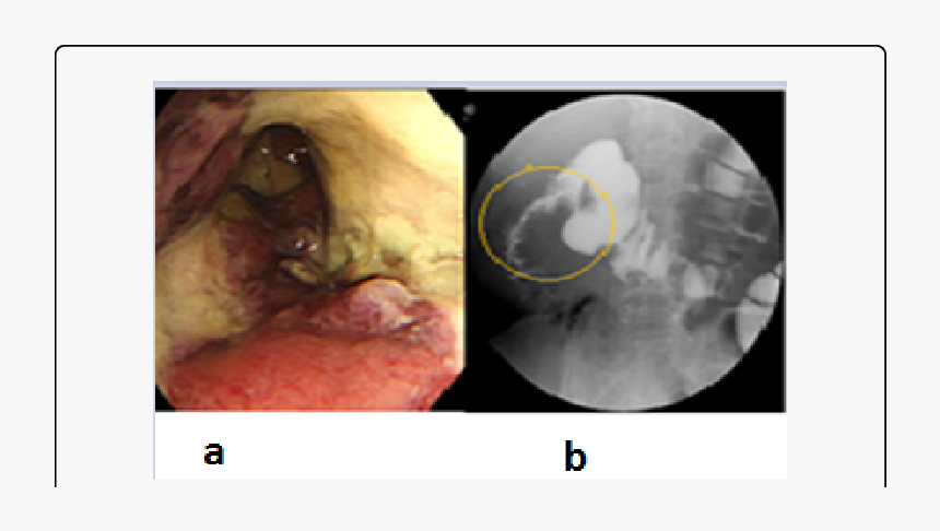 Colonoscopy Revealed A Circumferential White Coat And - Medical Imaging, HD Png Download