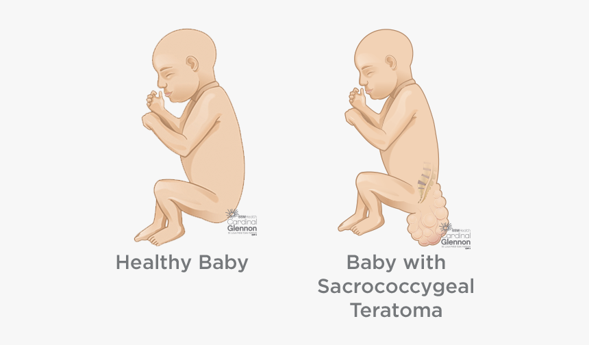 Sacral Teratoma, HD Png Download