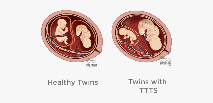 Image Of Healthy Twins In The Womb, Vs Image Of Twins - Twin-to-twin Transfusion Syndrome, HD Png Download