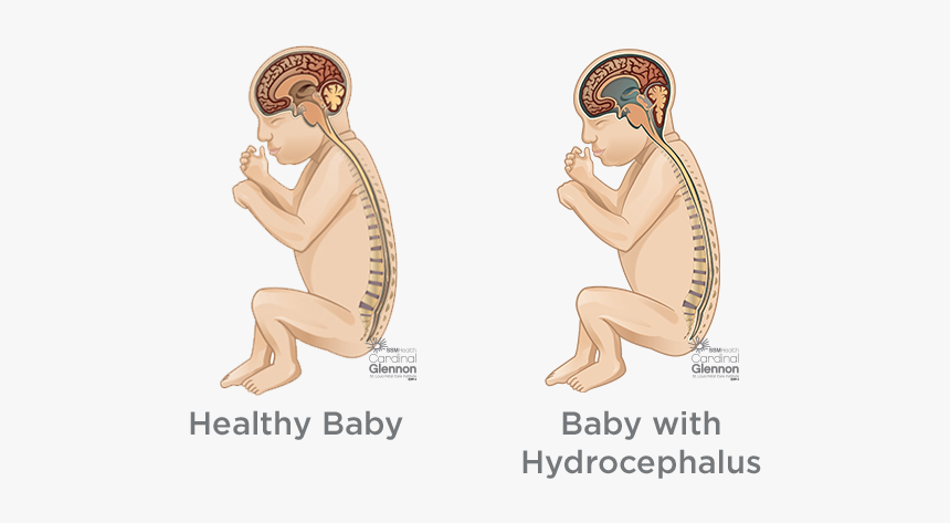 Hydrocephalus - Spina Bifida Before And After, HD Png Download