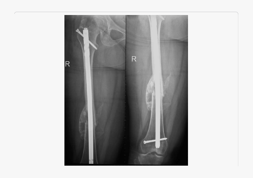 Showing X Ray Of Femur With Accelerated Fracture Healing - Healed Femur X Ray, HD Png Download