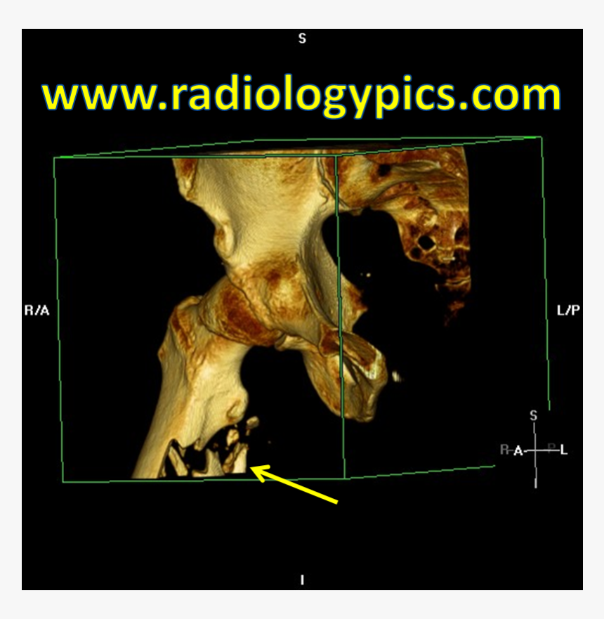 Subtrochanteric Femur Fracture - Computed Tomography, HD Png Download