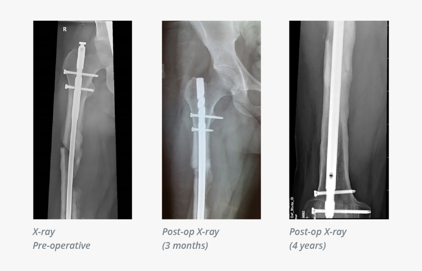Infected Non-union - X-ray, HD Png Download