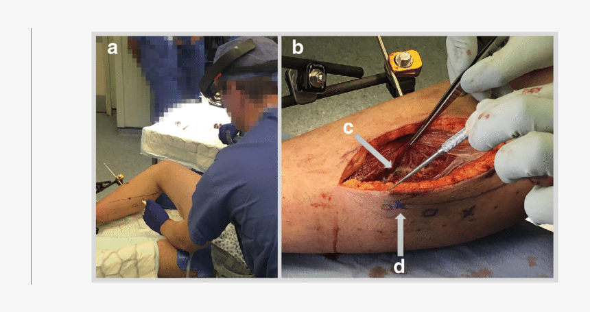 A Case 5 Marking Of Skin Under Hololens Guidance - Food Processing, HD Png Download