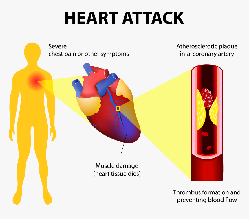 Heart-attack2 Adobestock - Heart Chest Pain, HD Png Download