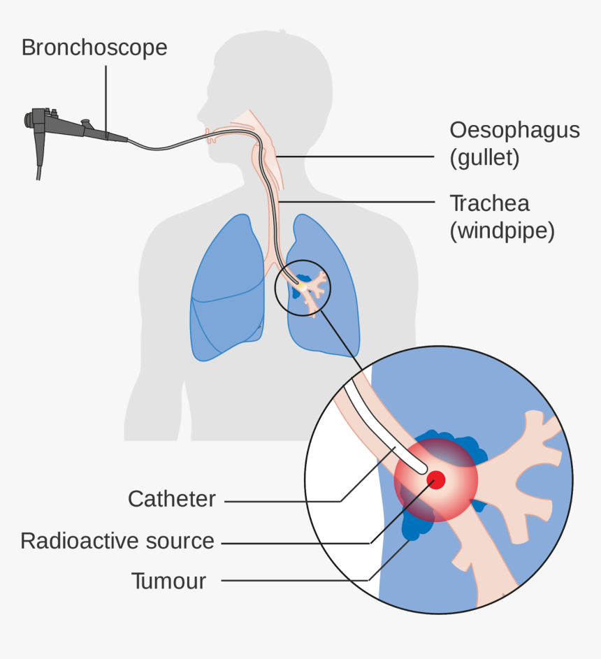 Lung Cancer Is The Leading Cause Of Death Due To Cancer, HD Png Download