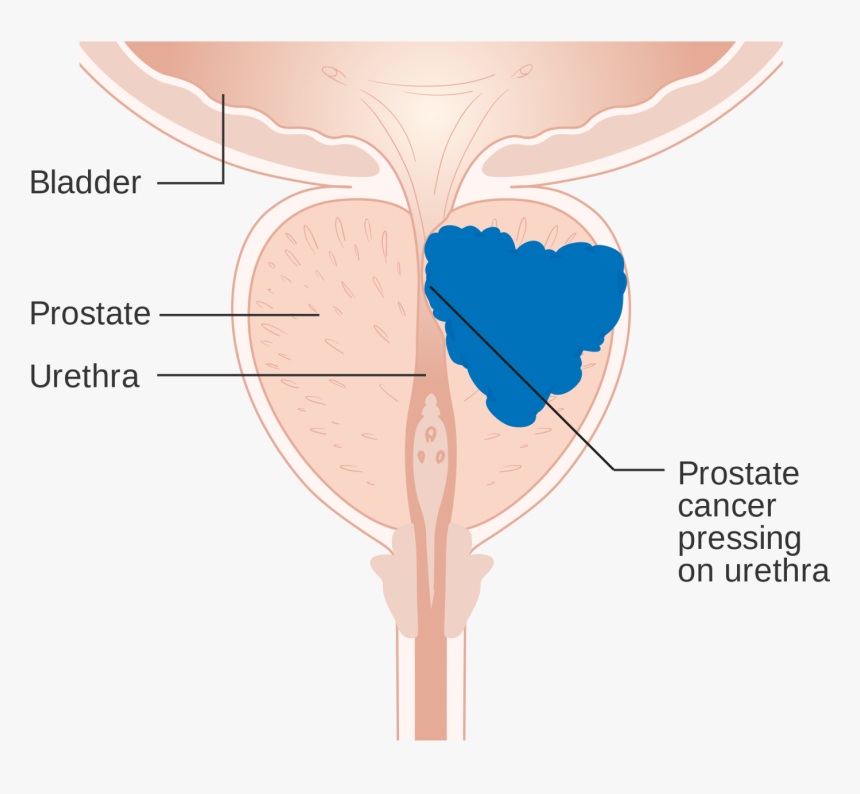 Prostate Cancer Diagram 
 Class Img Responsive Lazyload, HD Png Download