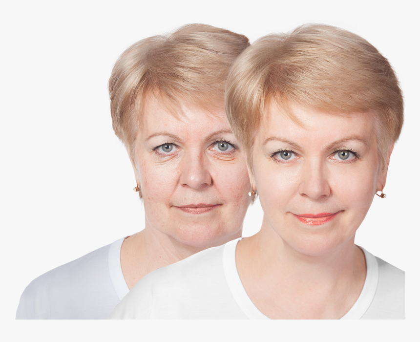 Before And After Image Of Woman S Face After Plastic - Girl, HD Png Download