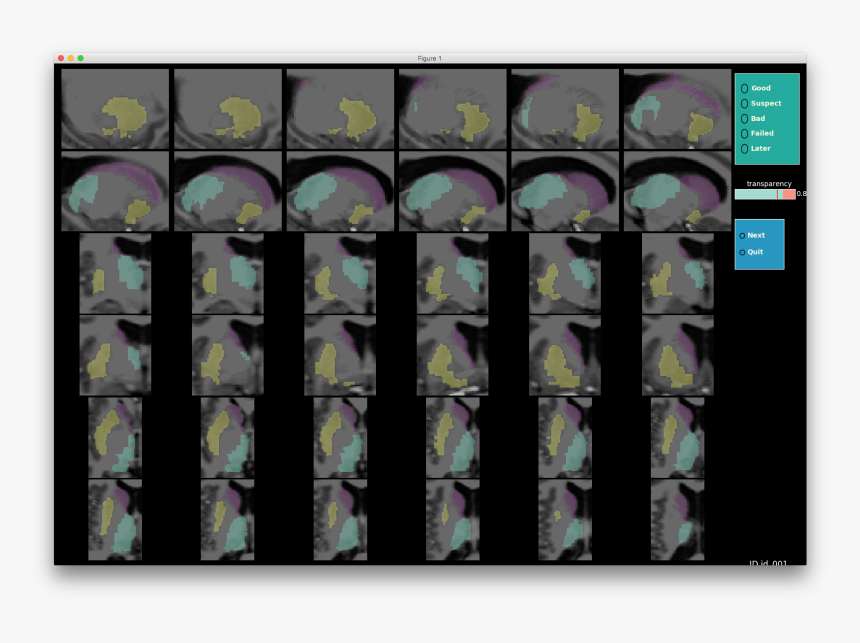 Images/subcortical Multiple, HD Png Download