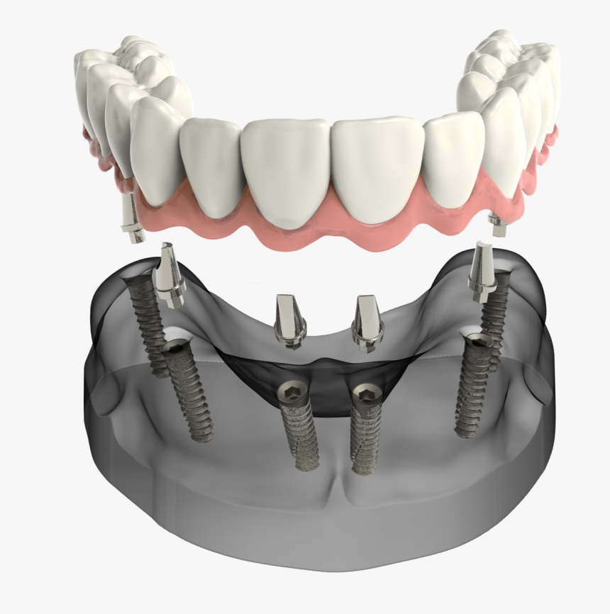 Implant Secured Denture Sudbury Ma Dentist, HD Png Download